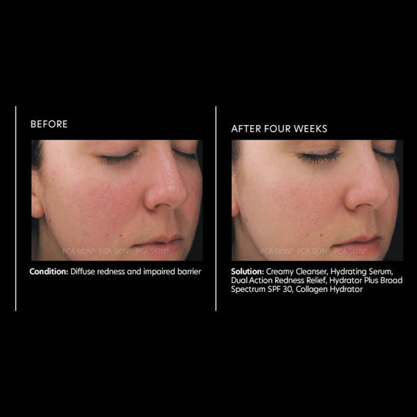 PCA Skin Dual Action Redness Relief 1 oz - European Beauty by B