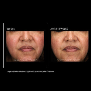 PCA Skin Resurfacing Serum 1 fl oz