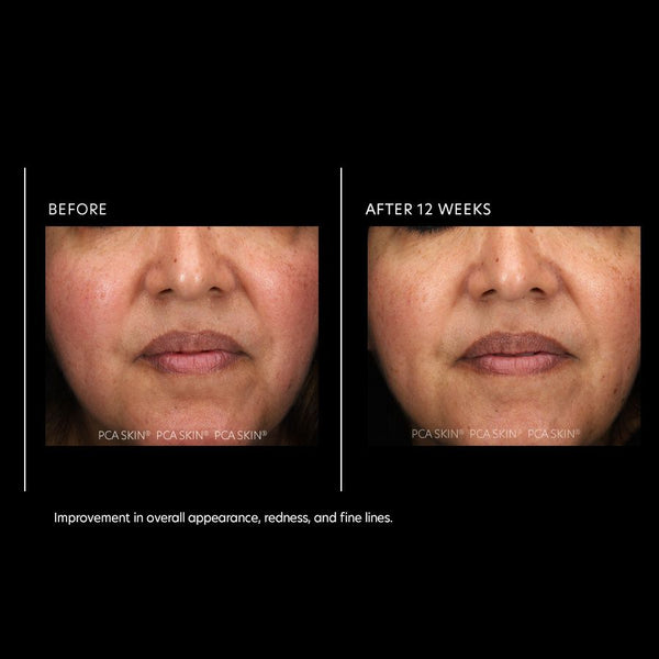 PCA Skin Resurfacing Serum 1 fl oz